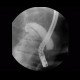 Stenosis of biliary duct, pancreatic carcinoma, ERCP: RF - Fluoroscopy